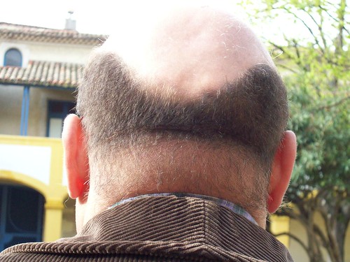 Calvitie. Male pattern baldness. by Only Tradition