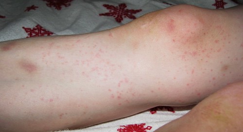 allergic reaction rash. allergic reaction to grass