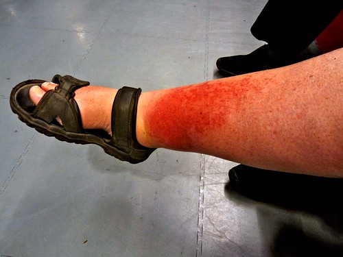 heat rash on legs pictures. Heat Rash