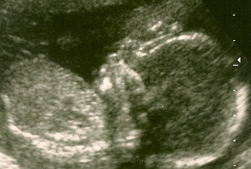sonogram 5 weeks. 18 week ultrasound