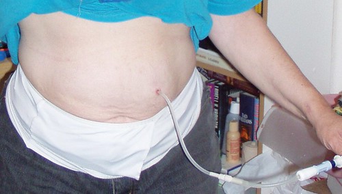 Abdomen with catheter showing