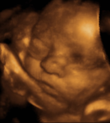 Emily 3D Ultrasound