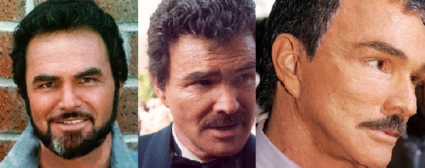 Disastres de cirurgia plástica de celebridades - Burt Reynolds