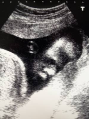 Baby2 Ultrasound 27 Weeks