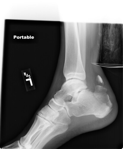 Image of a broken heel