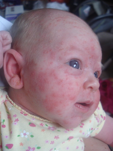 babies pimples