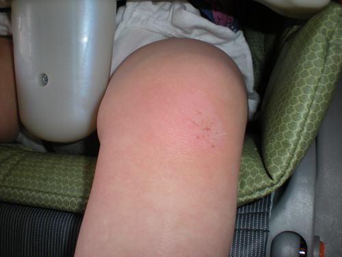 First skinned knee