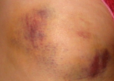 left ass bruise