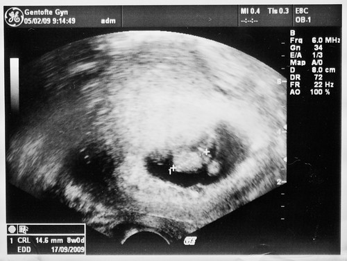 ultrasound 8 weeks. Ultrasound 8 weeks 0 days