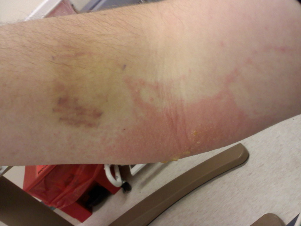 Arm at 11:30pm Monday, almost at its worst (angled slightly so you can see the oooooze)