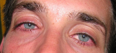 eyes & allergies