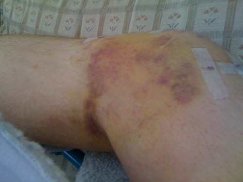 A lot of bruising early on