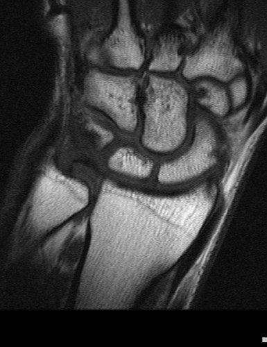 MRI of mature wrist