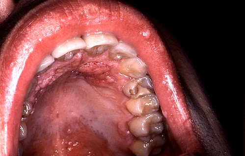 oral hpv