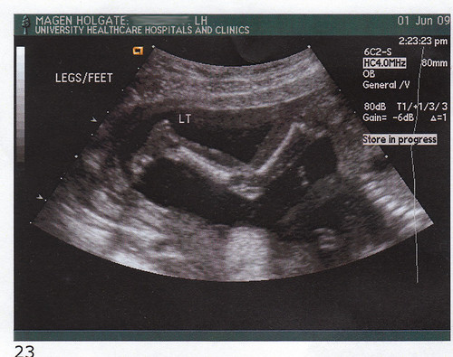 Ultrasound Leg