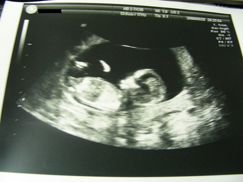 13週-第一孕期唐氏症篩檢-寶寶側面