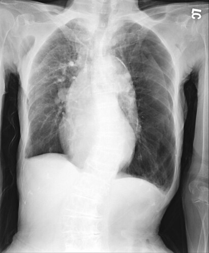 假pneumothorax