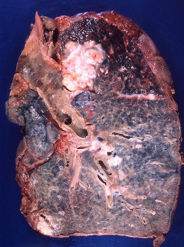 Mesothelioma Lung Cancer. asbestos lung cancer,