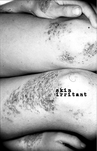 Various Artists - Skin Irritant