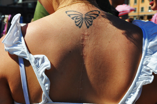 butterfly tattoo over scar Your tattoo can be featured here