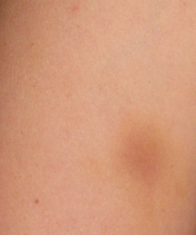Left Tricep Bruise
