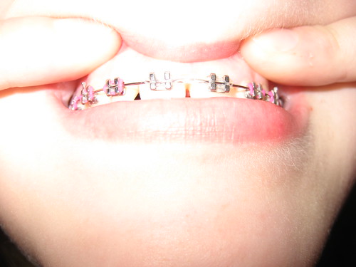 front teeth with plastic separator 