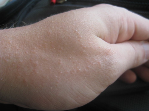 heat rash on face treatment. heat rash on hands and feet.