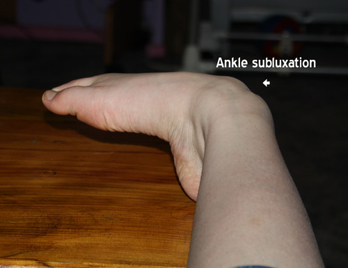 Ankle Subluxation