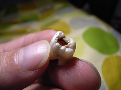 Carious tooth