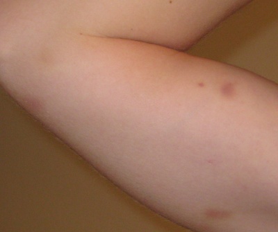 Right Bicep Bruises