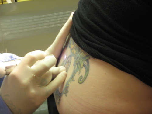 tattoo laser removal. cascioli