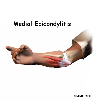 Medial Epicondylitis (Golfer's Elbow)