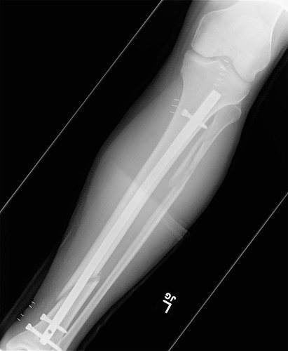 broken leg pictures. Broken Leg with Rod X-Ray