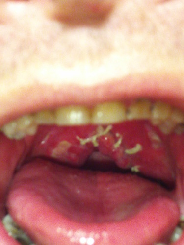 tonsils taken out. big globs when Taken out