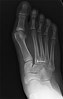 Lisfrancs Injury on X-ray