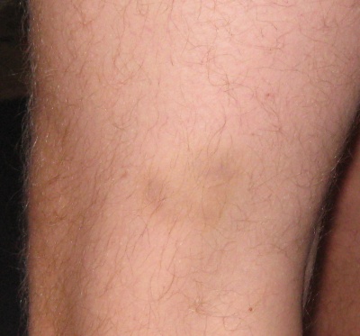 Left Thigh Bruise