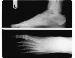 20090312 - Clint - foot x-ray - left ("go...