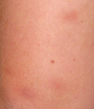 Left Elbow Bruises
