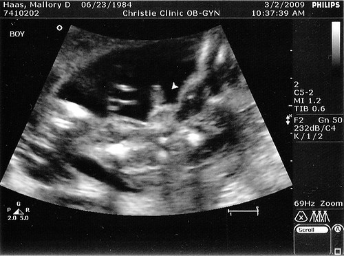 fetus at 6 weeks. +big+is+a+fetus+at+6+weeks