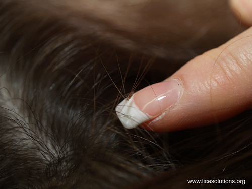 Hair With Lice. Head Lice - Louse blending