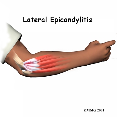 Tennis Elbow Pain In Forearm - Lateral Epicondylitis