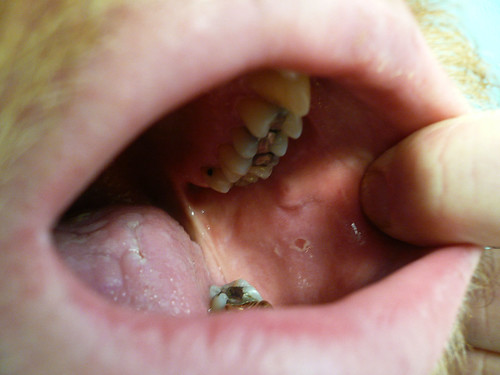 lesions in mouth