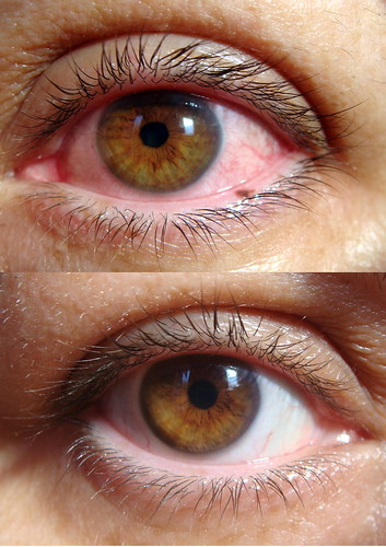Bacterial pink-eye, which usually produces a mucous discharge, pink eye