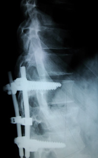 Titanium pedicle screws, From ImagesAttr