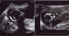 mini-mick 2 ultrasound at 18 weeks