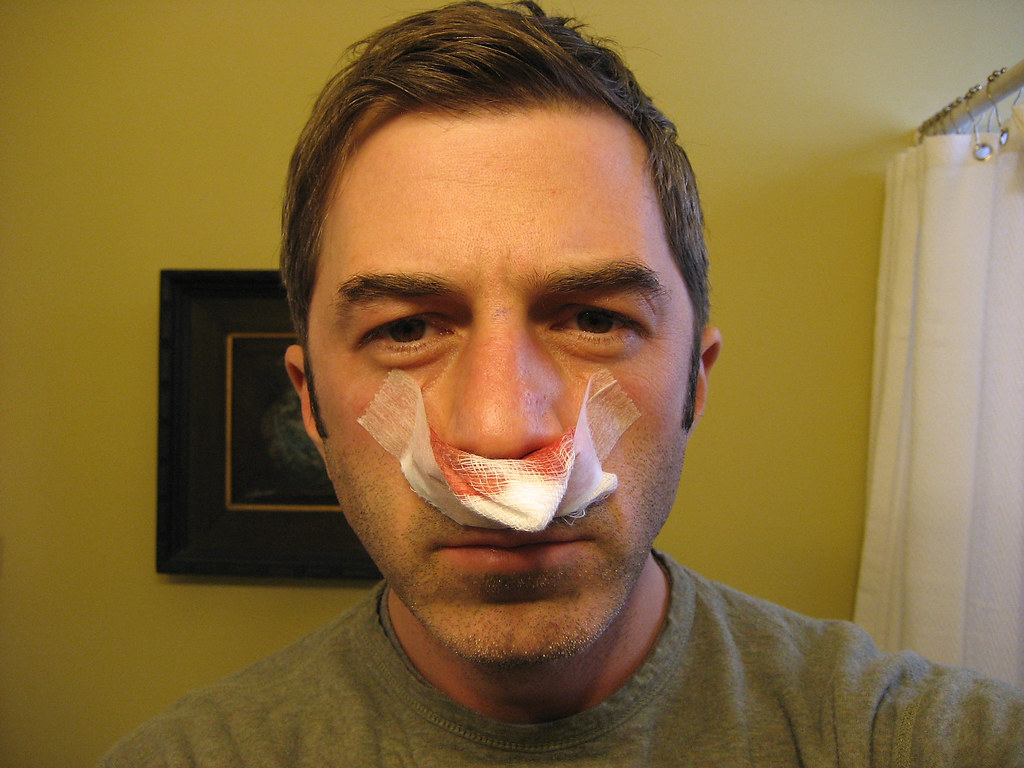 Septoplasty research paper