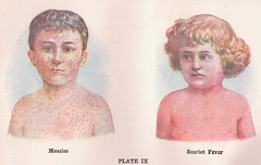 measles, reporting on health
