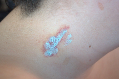 Hickey with purple bits covered in green corrector-concealer marks