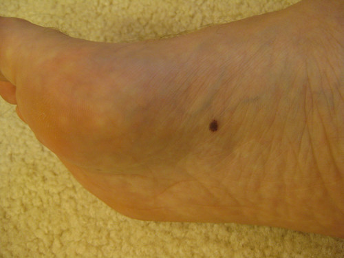 If you see a spot like this or anything unusual on your feet, visit a podiatrist to rule out cancer