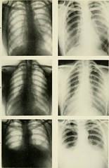 Anglų lietuvių žodynas. Žodis interstitial pneumonia reiškia tarpo plaučių uždegimas lietuviškai.